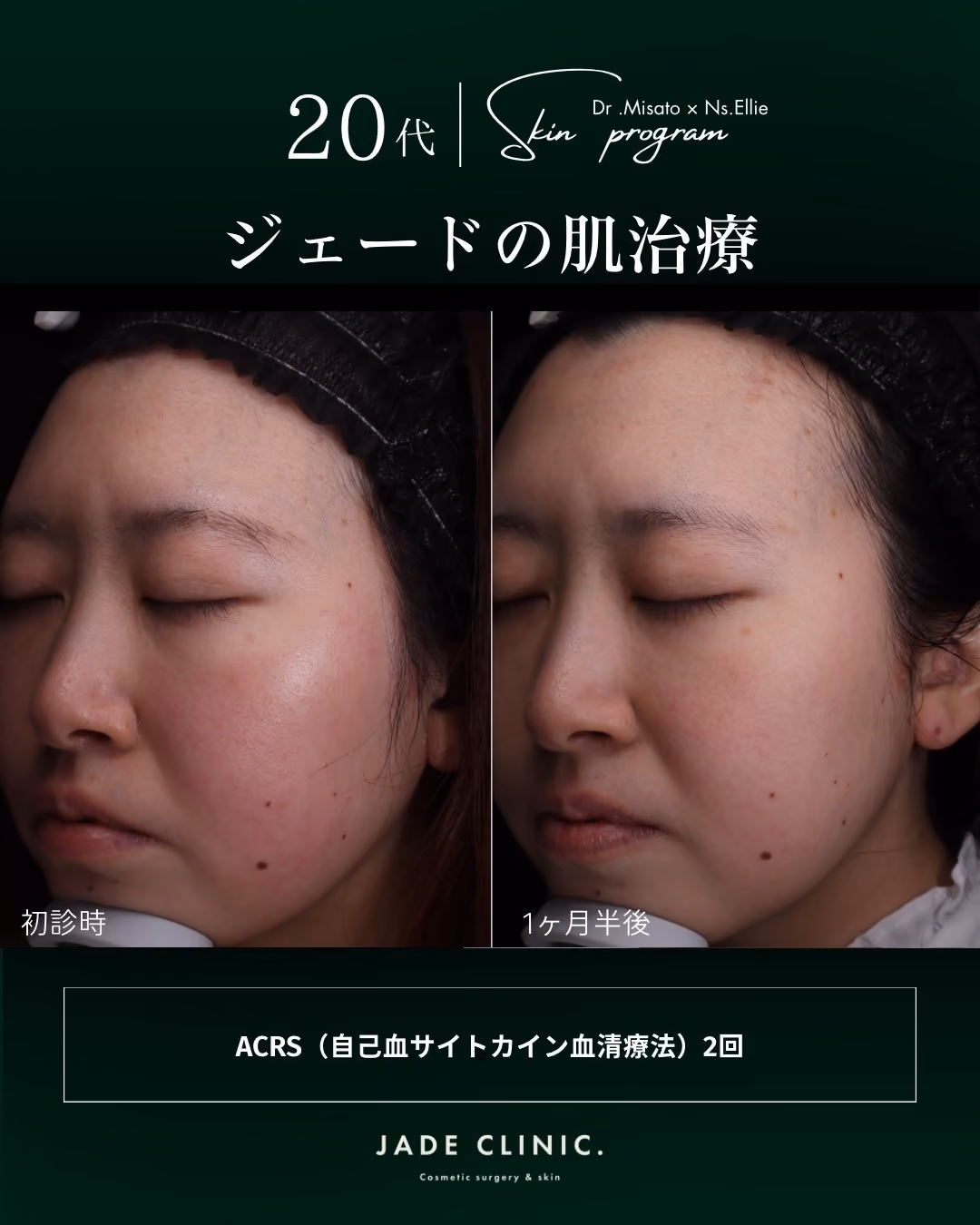 ACRSの仕組み｜抗炎症サイトカイン