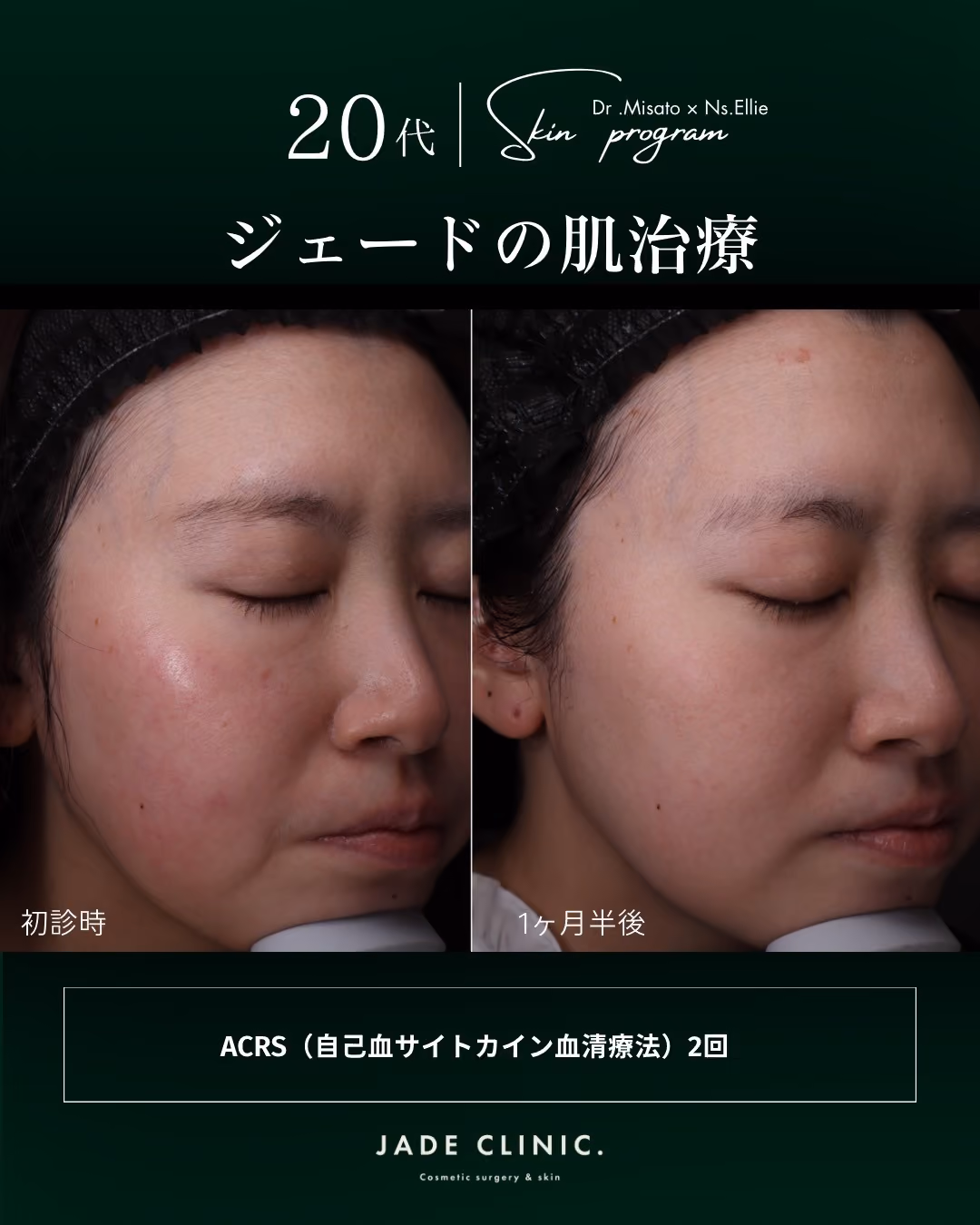 ACRS自己血サイトカイン治療｜症例4｜JADE CLINIC.