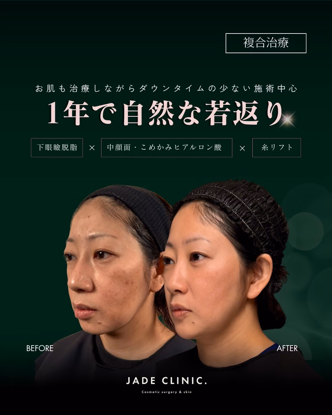 肌治療＋複合若返り1年｜症例タイトル｜JADE CLINIC.