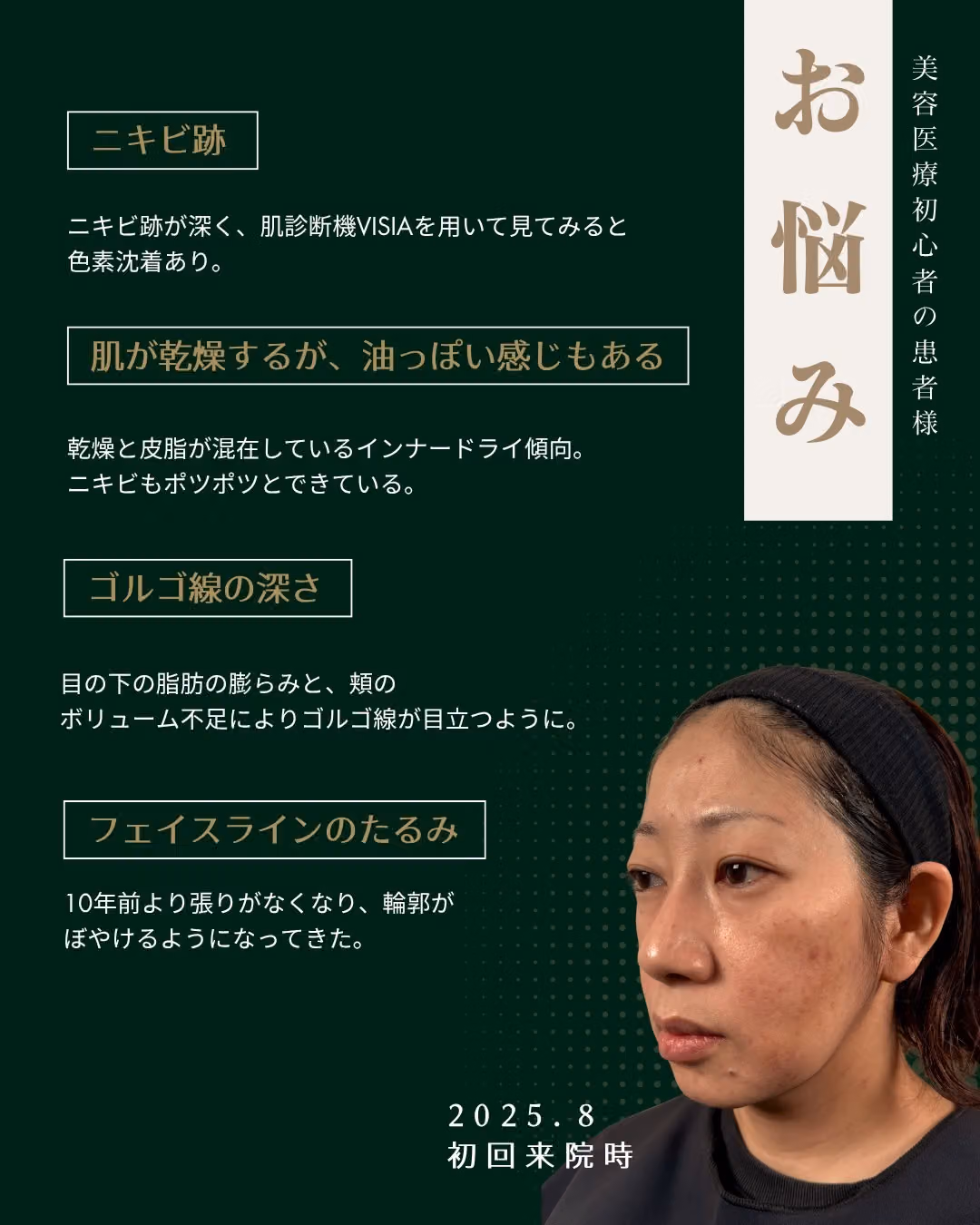 治療前｜たるみ・目の下のクマ・頬の位置