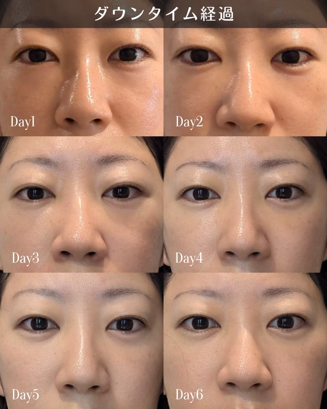 肌治療＋複合若返り1年｜症例4｜JADE CLINIC.
