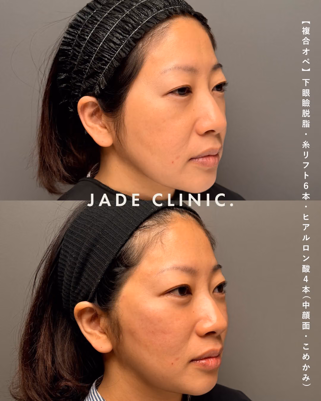 肌治療＋複合若返り1年｜症例6｜JADE CLINIC.