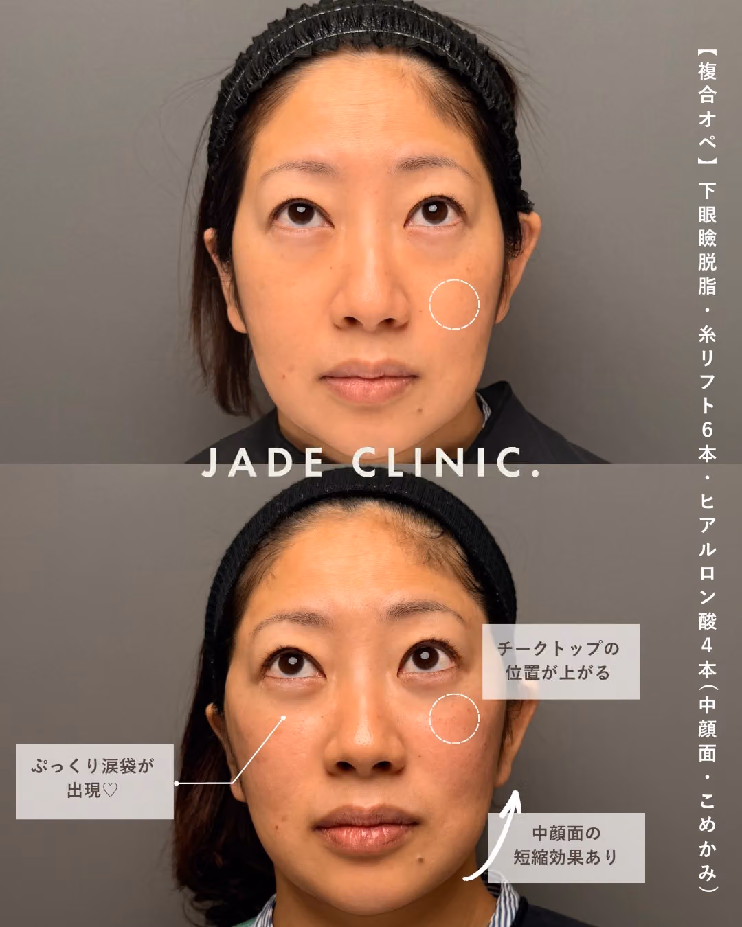 肌治療＋複合若返り1年｜症例7｜JADE CLINIC.