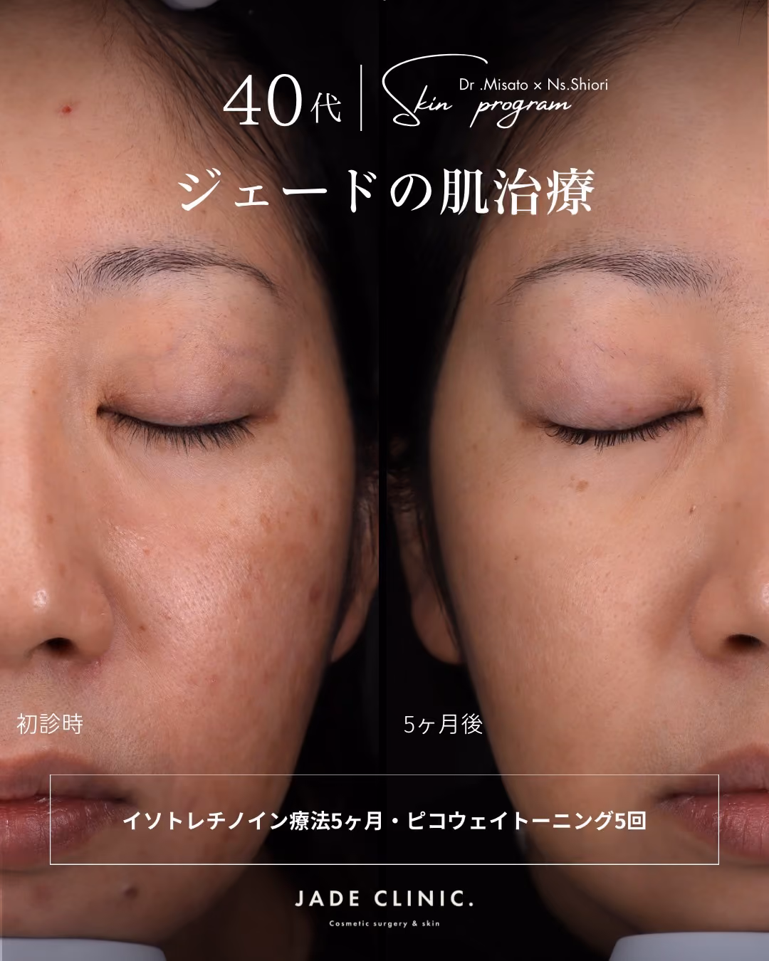 大人ニキビ肌質改善｜症例タイトル｜JADE CLINIC.