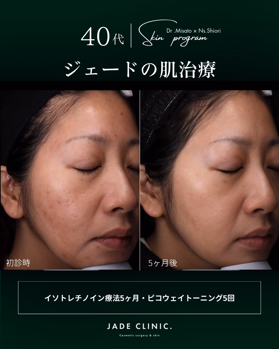 治療前｜繰り返す大人ニキビ・赤み・毛穴