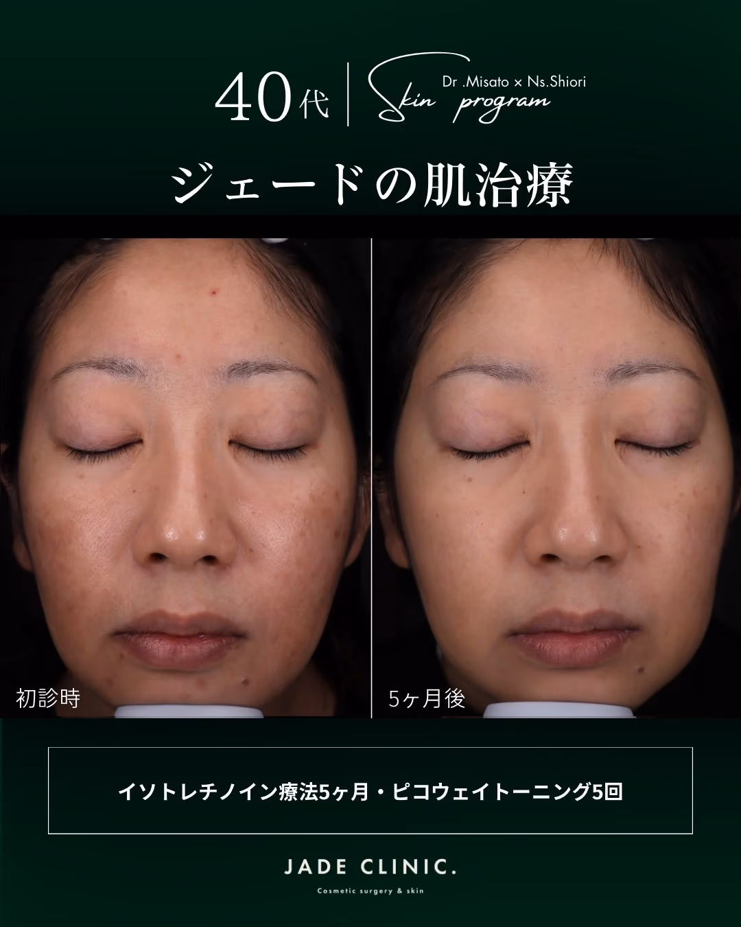 大人ニキビ肌質改善｜症例3｜JADE CLINIC.