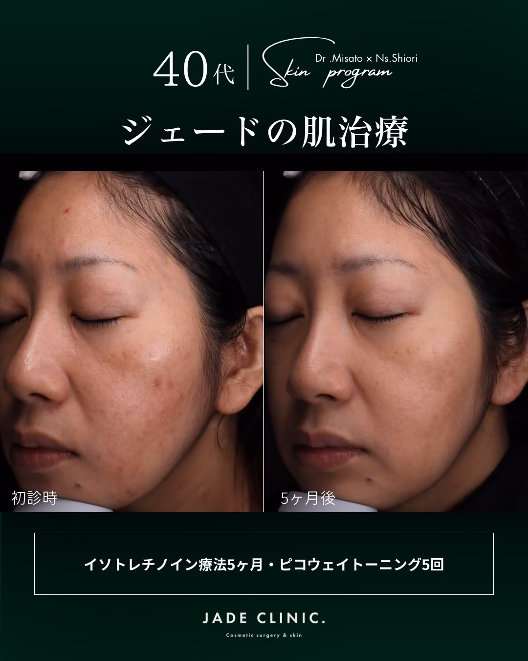 大人ニキビ肌質改善｜症例4｜JADE CLINIC.